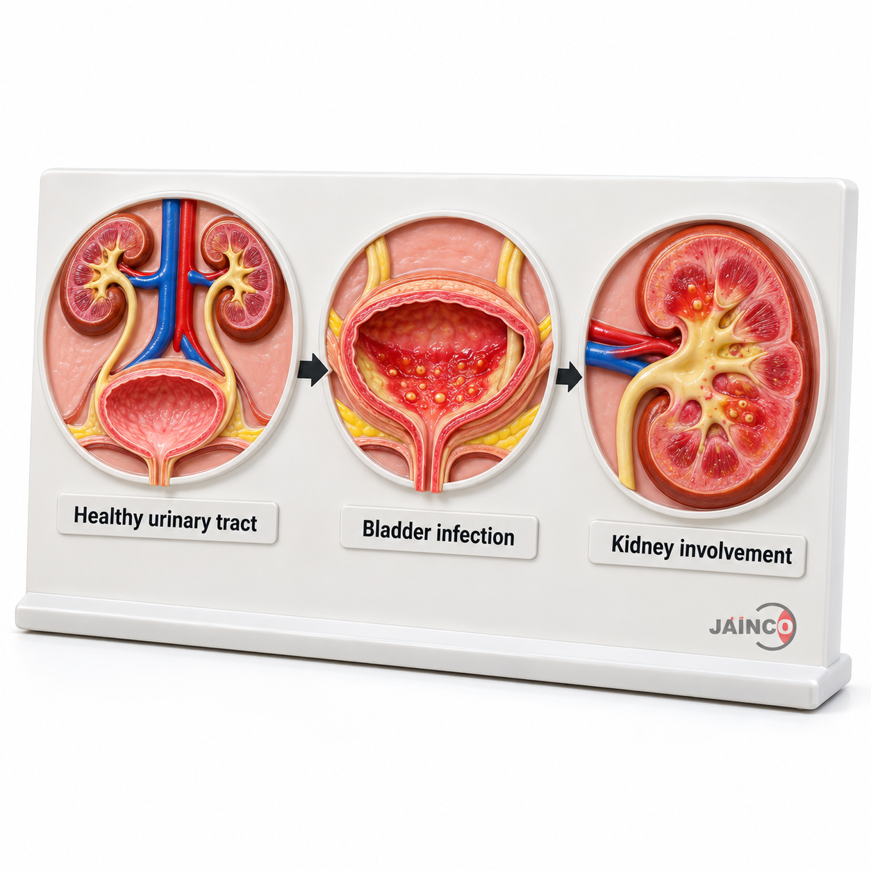 Disease Summary of UTI Model